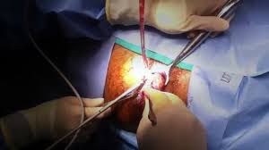 Affordable solutions for hemorrhoid laser in Mashhad